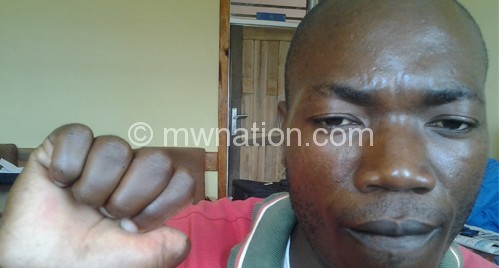 Thumbs down: Nyirenda shows the maimed finger