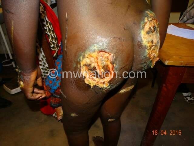 Wounds sustained by Linda phulani pics Mchinji Police  victim support unit