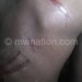 Kathewera was injured during the fracas
