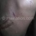 Kathewera suffered injuries during the fracas