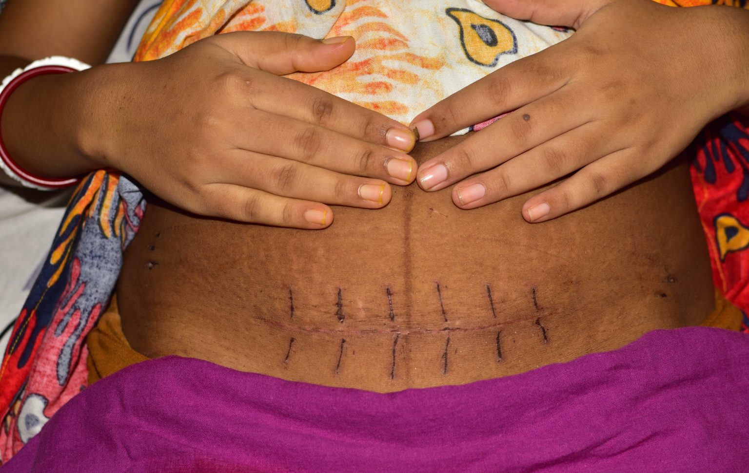 Promoting safe motherhood through safe C-sections - Nation Online